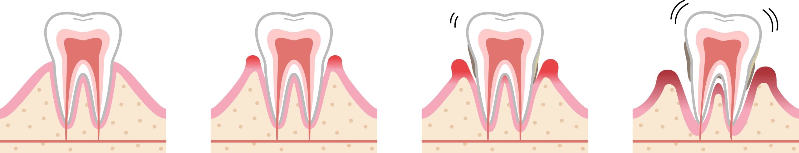 Illustration d'une gencive malade